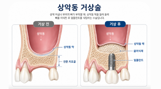 365라온누리치과 상악동거상술 사이너스리프트