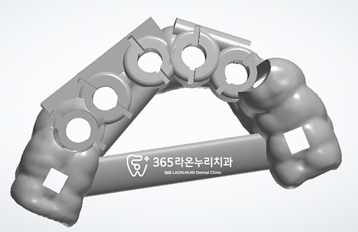 365라온누리치과 디지털 임플란트 3D CT 가이드 수술