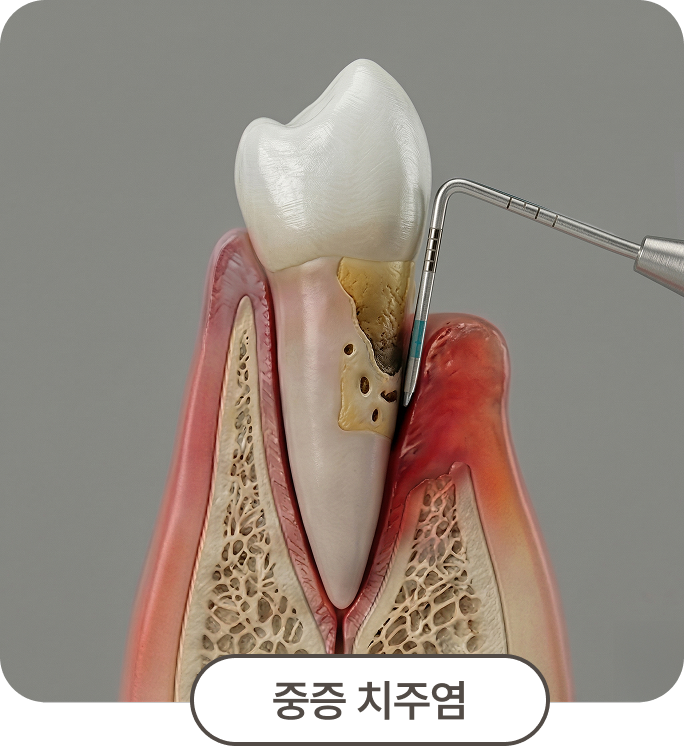 중증 치주염