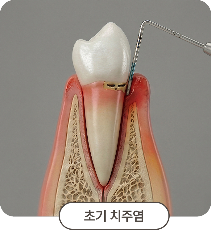 초기 치주염